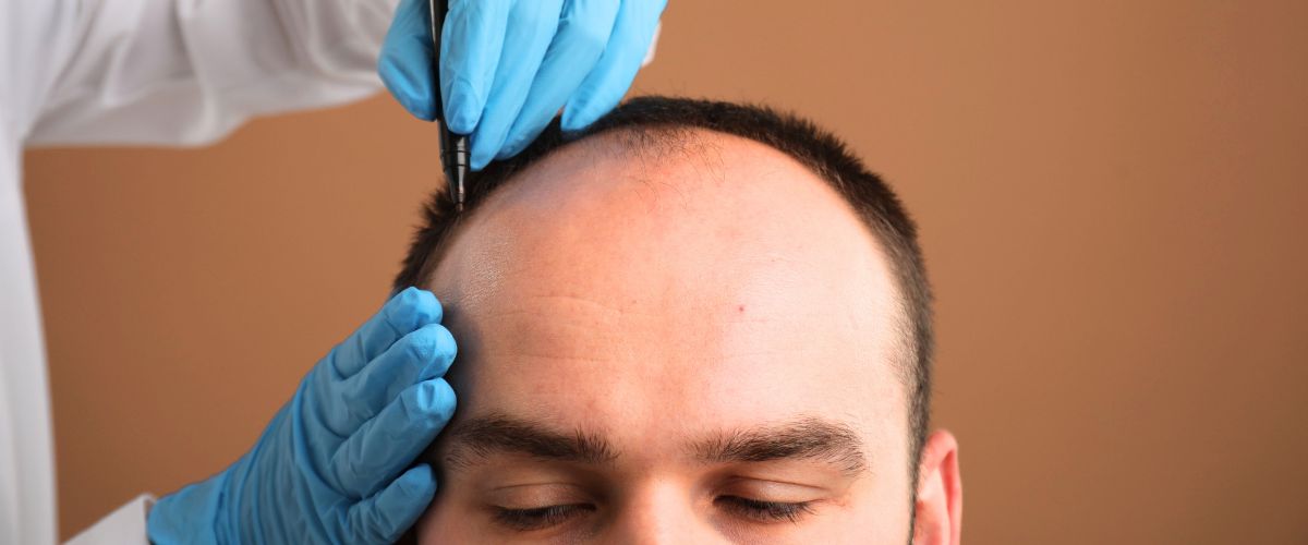 Patient's head before hair transplant surgery