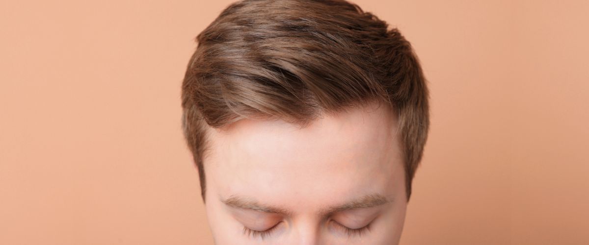 Man after hair loss treatment